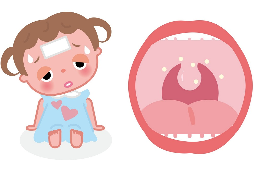 ヘルパンギーナの症状を表したイラスト