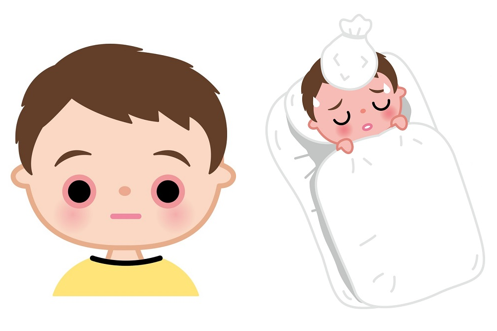 咽頭結膜熱（プール熱）の症状を表したイラスト
