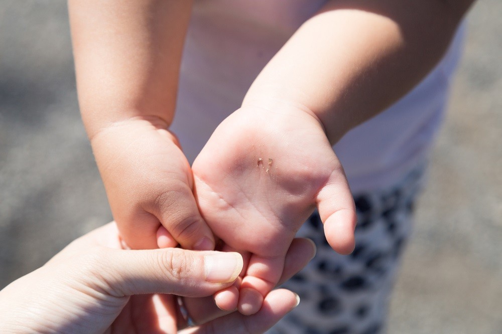 子どもの手のひらにできたすり傷