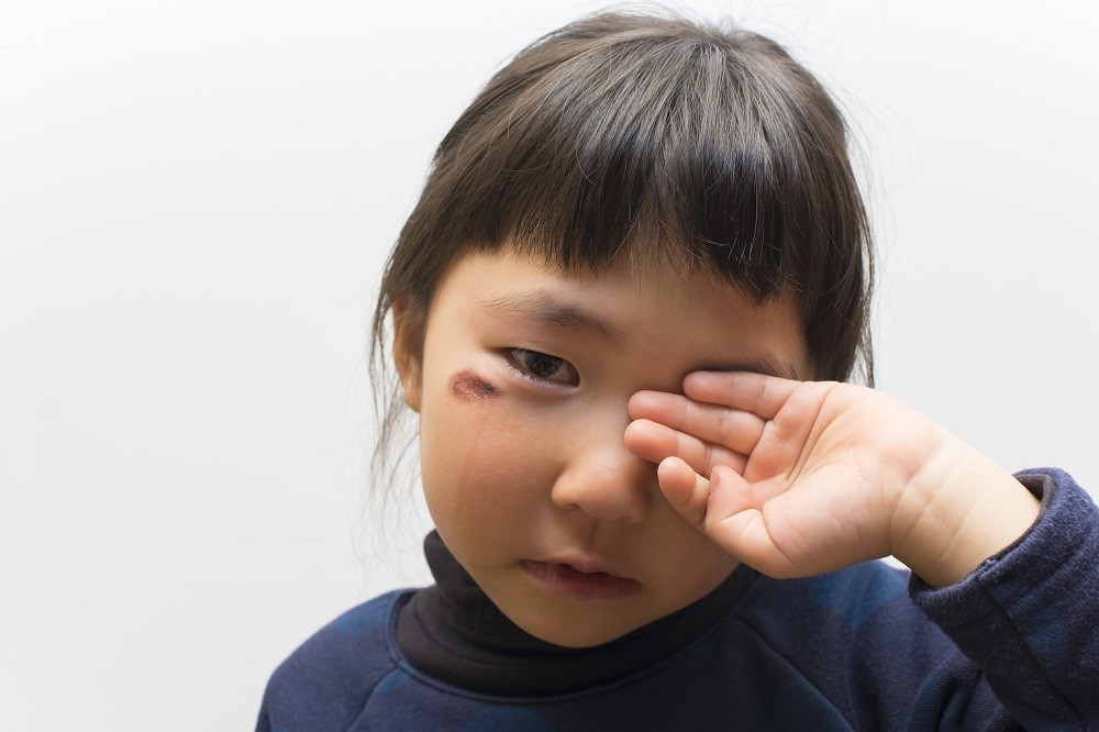 目の下にケガをして泣いている女の子