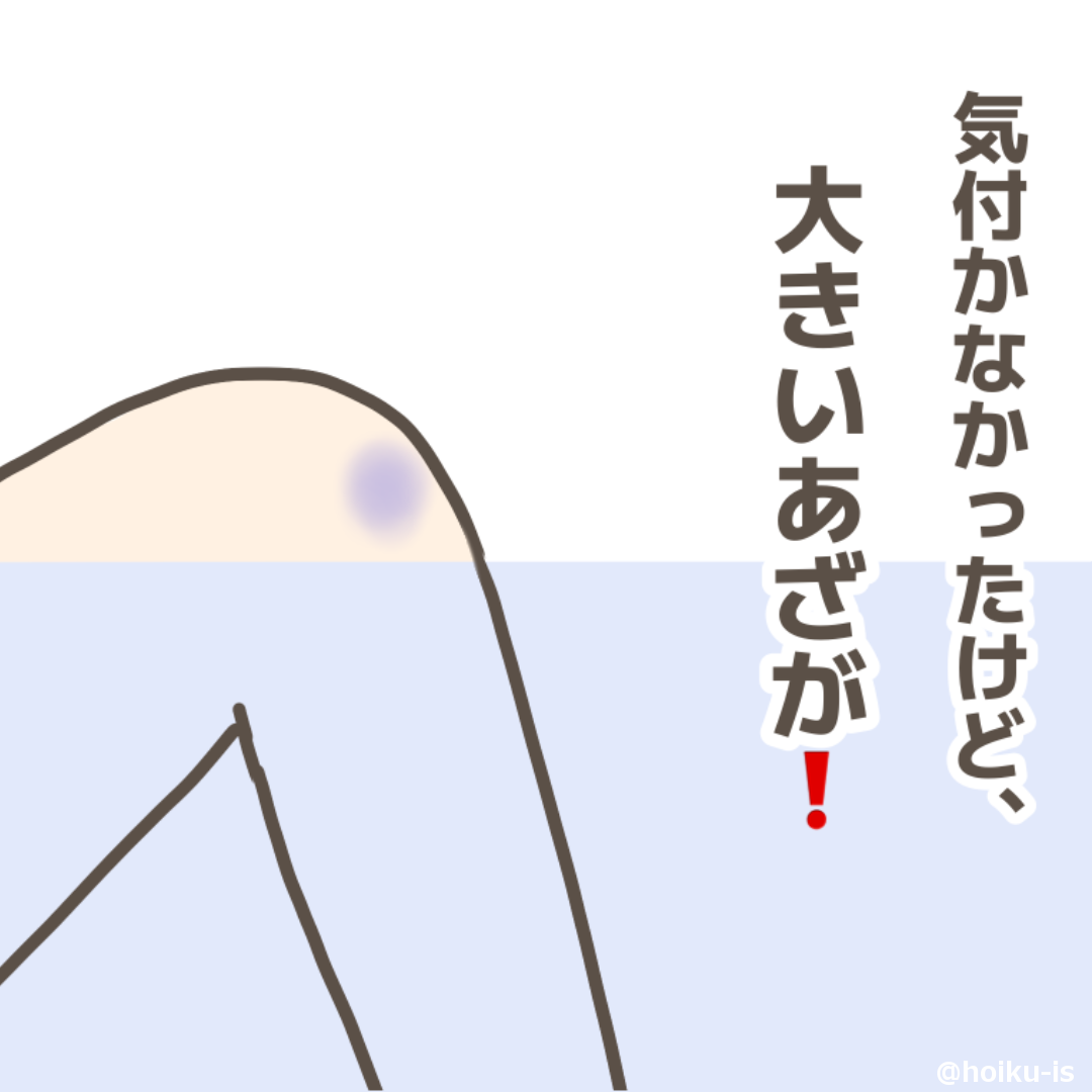気づかなかったけど大きなあざが