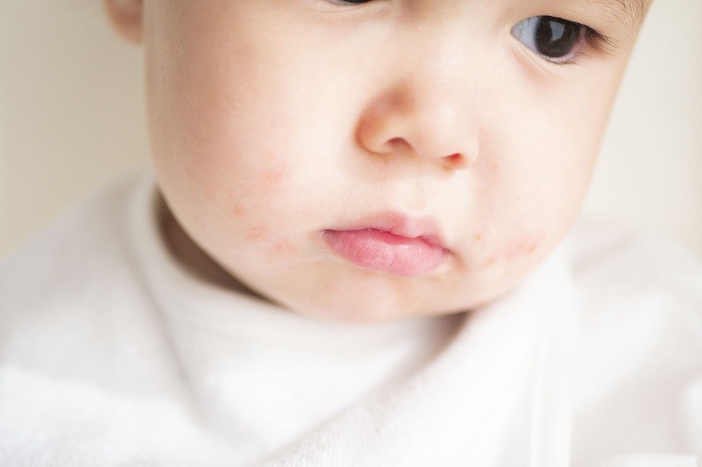 発疹ができた赤ちゃんの口元